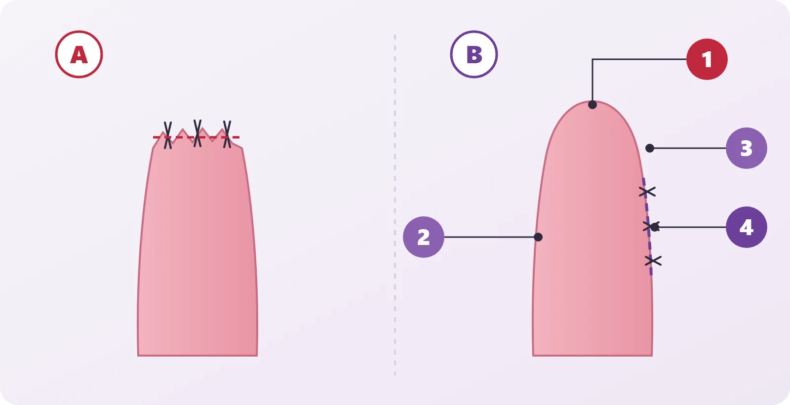 Two cross-section diagrams of the inner labium: on the left a notched edge with sutures on the free edge, on the right a smooth edge with the suture line moved to the outer side in the Güllüce Technique